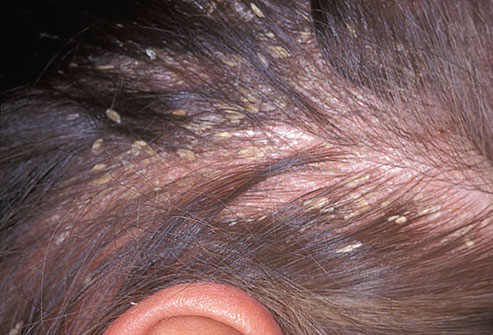 Yellow Dandruff?4 / 18
If the dandruff flakes you see are greasy and yellow, you may have seborrheic dermatitis. It's an inflammatory skin condition that can occur where there are lots of oil glands, like the scalp and face. Though seborrheic dermatitis is related to hormones, fungus and even some neurological conditions like Parkinson’s disease or HIV, these conditions are all treated the same as dandruff: with antidandruff shampoos.