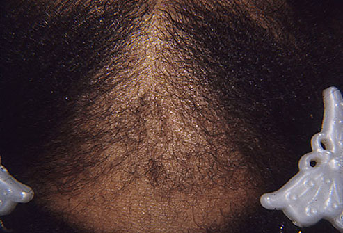 Traction Alopecia Damages Follicles14 / 18
Pulling hair too tight -- as can happen with ponytails, braids, and cornrows -- can damage hair follicles and cause hair to break or fall out. Hair extensions and hairpieces can sometimes cause traction alopecia, too, because their extra weight pulls on existing hair. Changing your hairstyle usually lets hair grow back. Pulling hair back tightly for a long time, though, can lead to permanent hair loss.