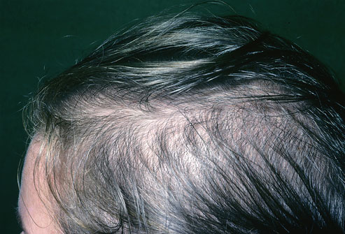 Female-Pattern Baldness9 / 18
Age-related thinning may mean hair thinning all over the head, but pattern hair loss is usually most common on top of the head. Unlike men, women rarely go bald, and they tend to lose hair more slowly than men do. Contrary to popular belief, longer hair won't put a strain on the roots, causing more to fall out. Nor will shampooing pull hair out -- it just gets the ones that were falling out already. Minoxidil 5% applied once daily may help hair growth and prevent thinning. Spironolactone and Flutamide (oral medications) can also be used in women.